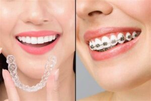 Orthodontic Treatment in Bedok Singapore