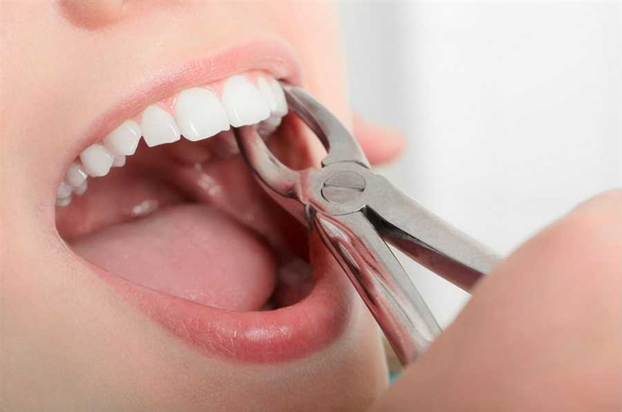 Tooth Extraction in Bedok Singapore