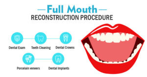 Full Mouth Rehabilitation in Bedok