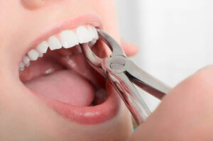 Tooth Extractions in Bedok