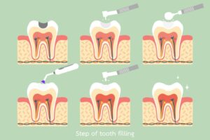 Dental Fillings in Bedok