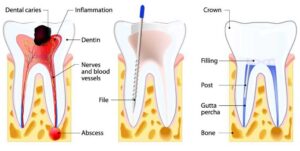 Root Canal Treatment in Bedok