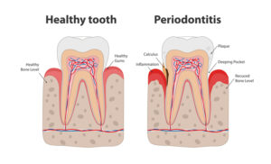Periodontal and Gum Treatment in Bedok, Singapore