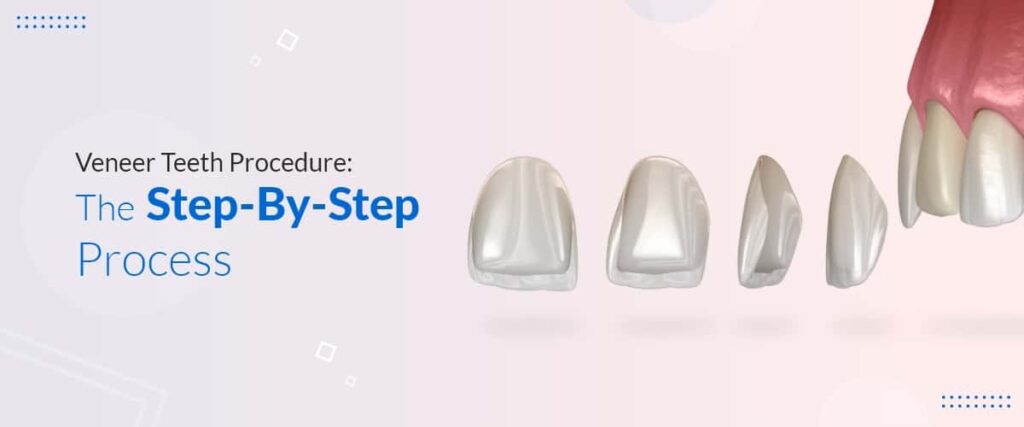 he Dental Veneers Procedure in Bedok , Singapore